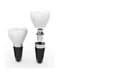 Dental Implants