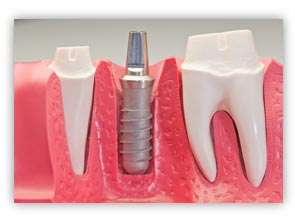 When to get dental implants