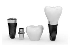 Types of dental implants