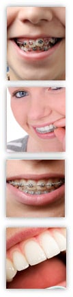 when to get braces
