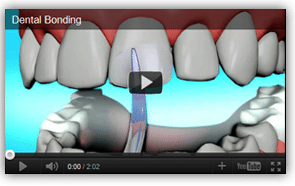 Tooth Bonding Video | ACE Dental Resource